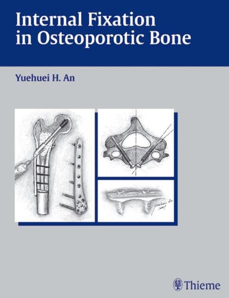 medical/orthopaedics/internal-fixation-in-osteoporotic-bone-9781588900876