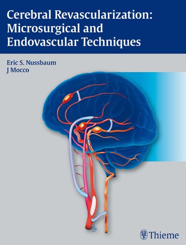 medical/neurology/cerebral-revascularization-microsurgical-and-endovascular-techniques-9781604062632