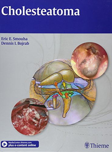 medical/otolaryngology/cholestreatoma-9781604062779