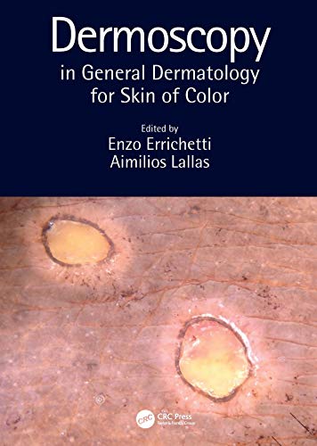 DERMOSCOPY IN GENERAL DERMATOLOGY FOR SKIN OF COLOR