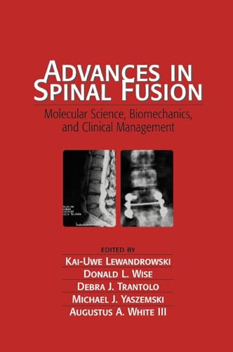 ADVANCES IN SPINAL FUSION:MOLECULAR SCIENCE,BIOMECHANICS AND CLINICAL MANAGEMENT medical/neuro-surgery/advances-in-spinal-fusion-molecular-science-biomechanics-and-clinical-management-9780824743109